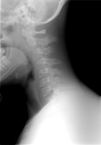 An x-ray showing the upper cervical spine